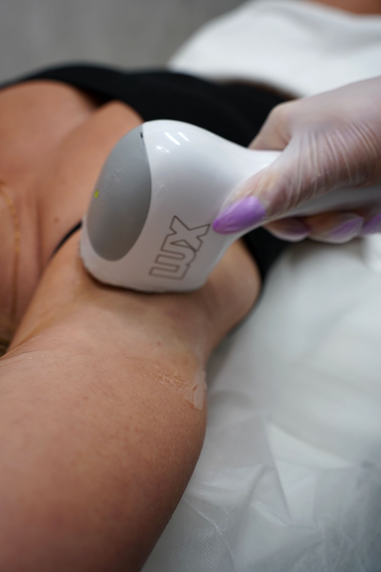 The Skyn Lux handpiece in close up during treatment